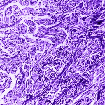 Гистология рака молочной железы