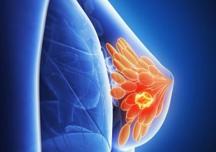 Комбинация палбоциклиба с летрозолом эффективна у пациенток с распространенным раком груди
